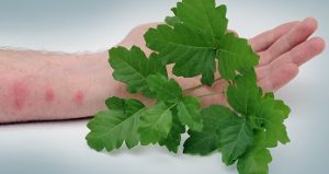 Poison Oak with Skin Rash