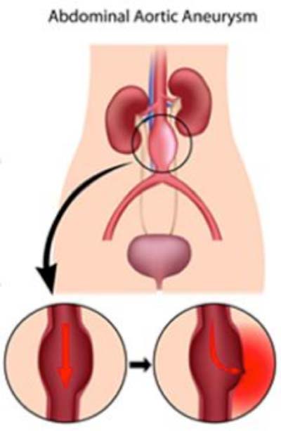 abdominal-aortic-aneurysm